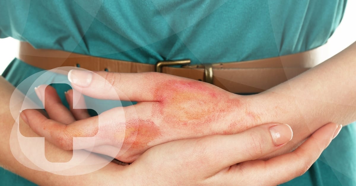 A lady's hand with large burns being cradled by the other hand