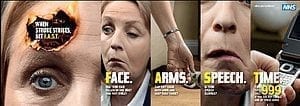 Woman with facial paralysis in a series of pictures to show what a stroke looks like