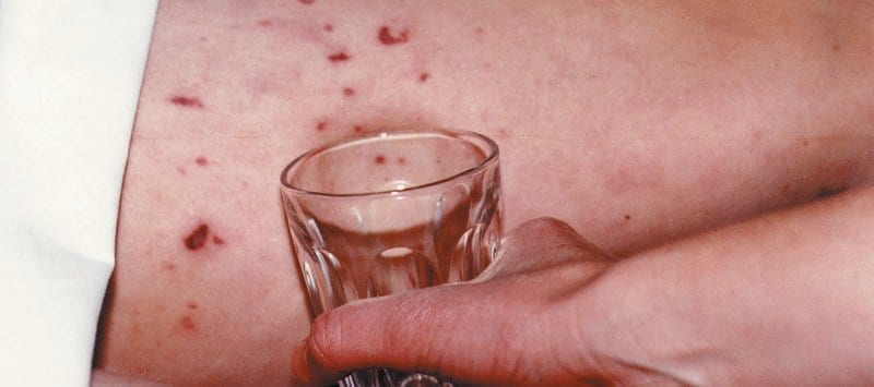 A glass being pressed up against a meningitis spot.