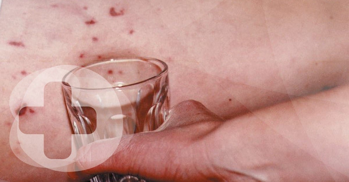A glass being pressed up against a meningitis spot with a Skillbase first aid logo watermarked.